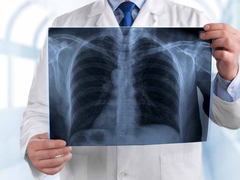 Allarme polmonite: ASST Mantova attiva un protocollo di emergenza