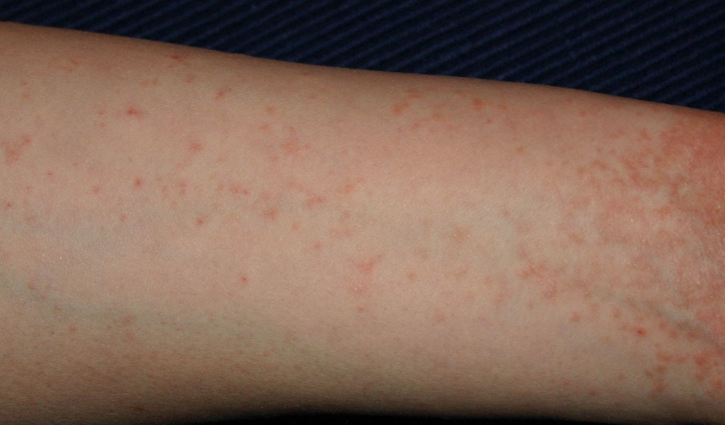 Allarme scabbia a scuola: 7 alunni contagiati