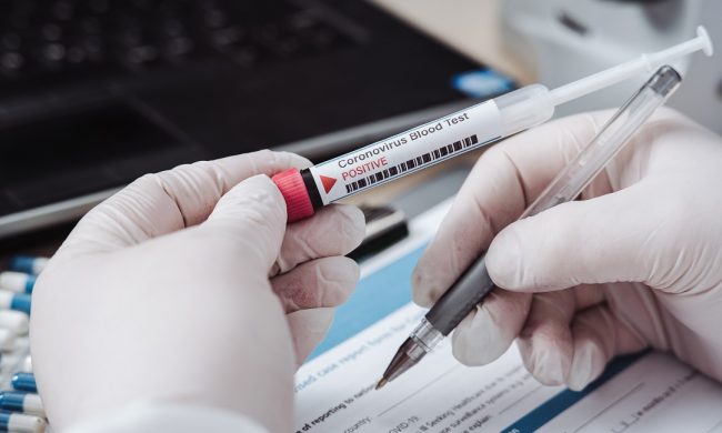 Nuovo test sierologico economico e facilmente eseguibile da tutti i laboratori di ricerca: lo studio