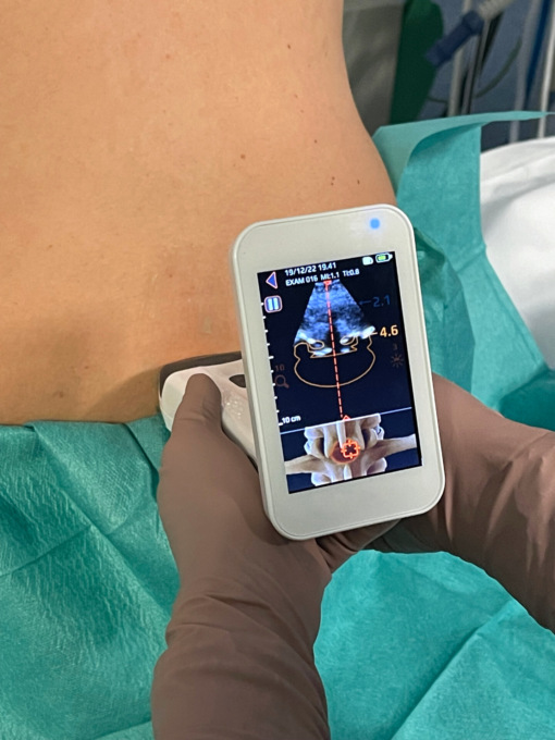 Al Poma un ecografo 3D: epidurale e spinale più semplici