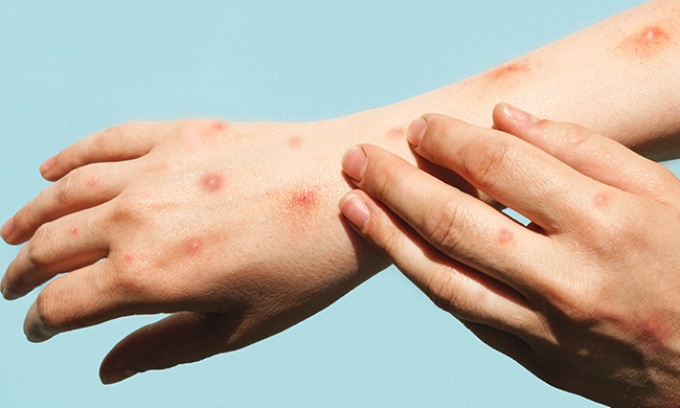 Riscontrato un caso di vaiolo delle scimmie in una scuola in provincia di Brescia